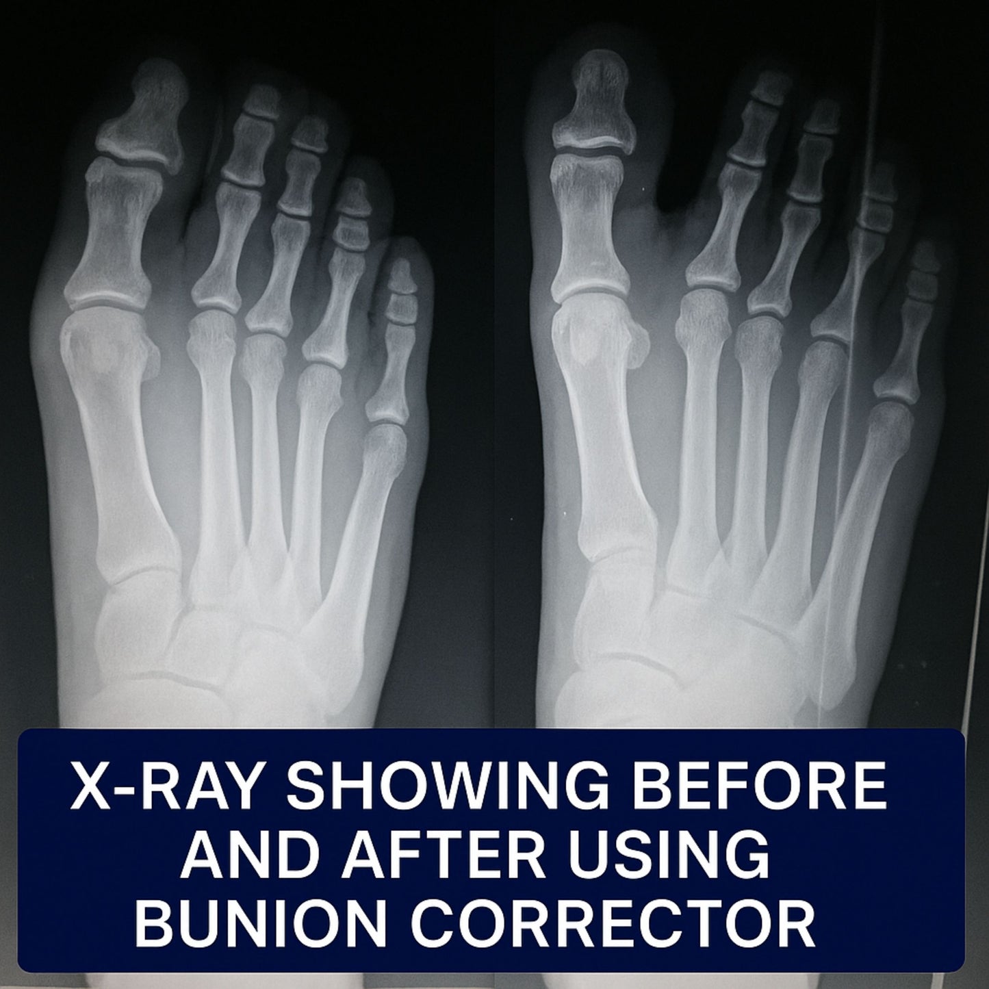 Bunion Corrector