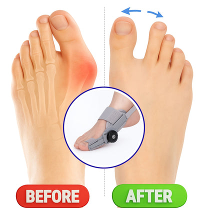 Bunion Corrector
