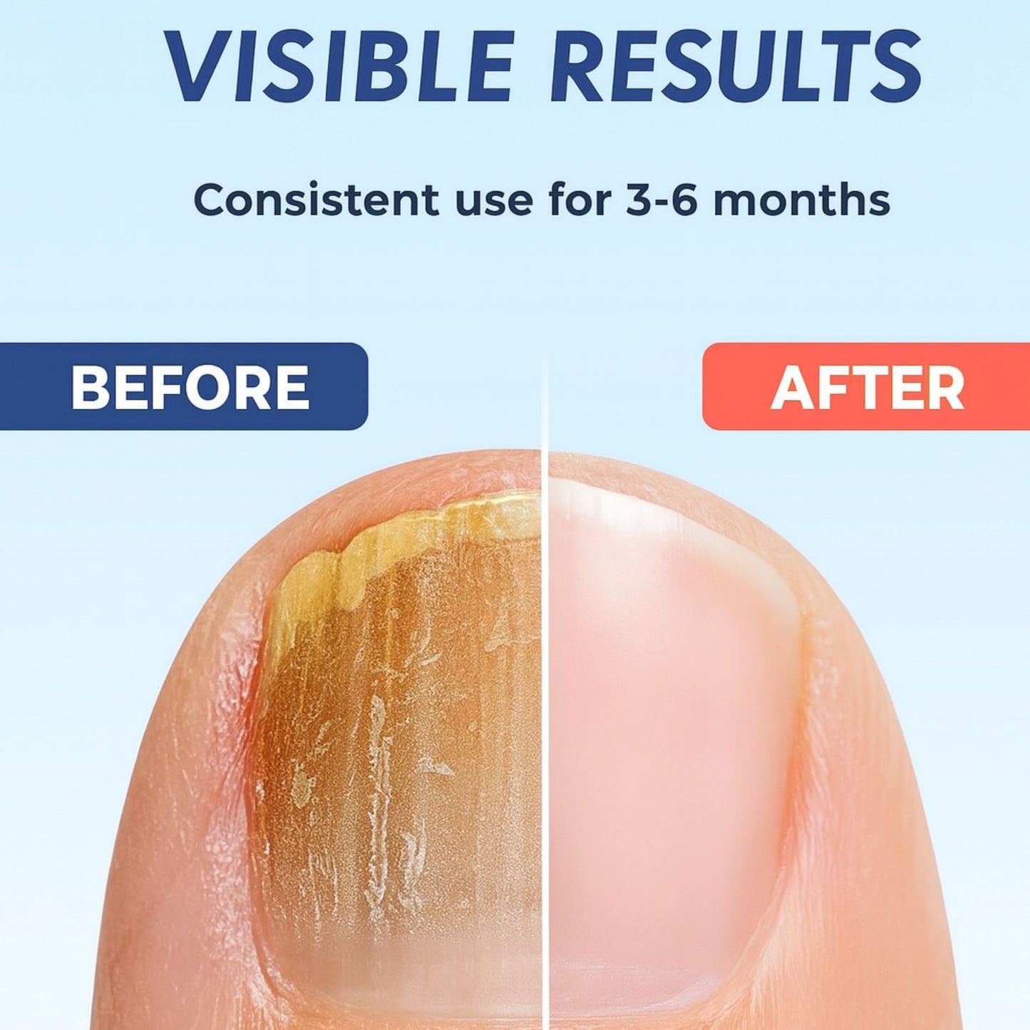 Blue Beam Nail Fungus Remover